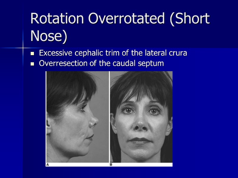 Rotation Overrotated (Short Nose)  Excessive cephalic trim of the lateral crura  Overresection